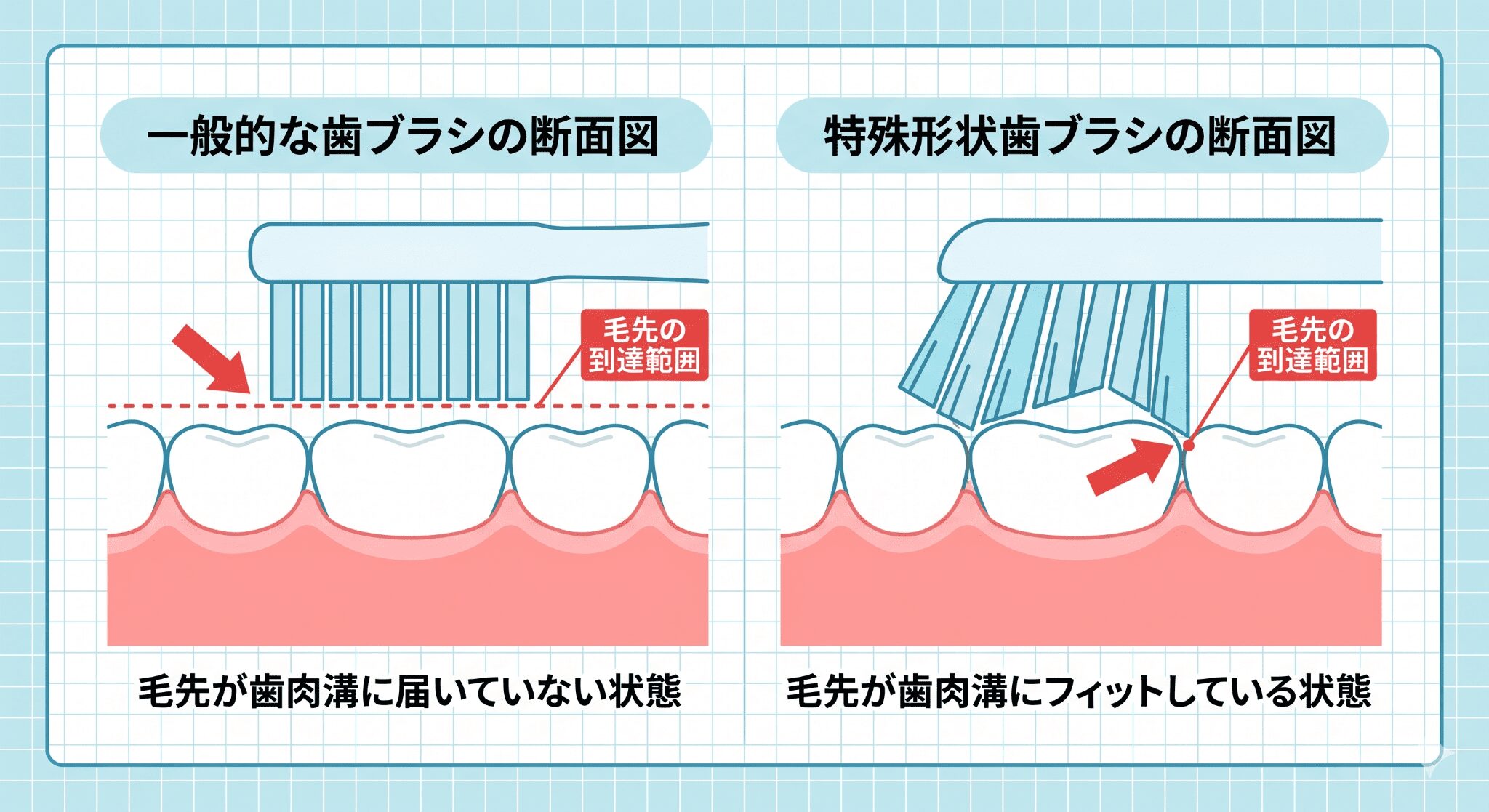図の左側は一般的な歯ブラシ、右側は特殊形状の歯ブラシを使った歯磨きの様子を示しています。左側では、歯ブラシの毛先が歯肉溝まで届いていないため、歯肉溝に汚れが残ってしまう様子が描かれています。一方、右側では、特殊形状の歯ブラシの毛先が歯肉溝にまでしっかりと届いている様子が描かれています。